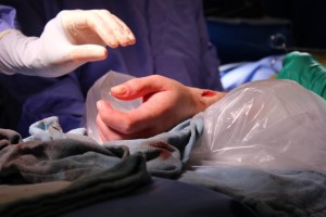 hand transplant 6