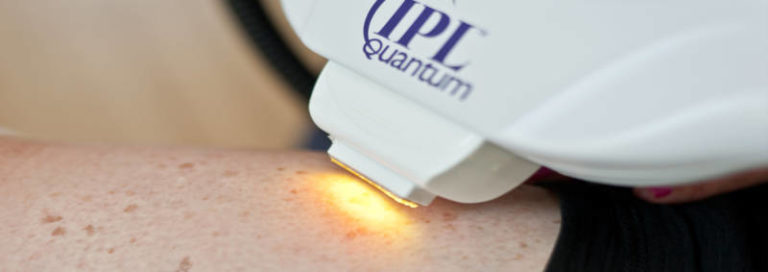 Rejuven-Age. Sun spot and brown spot removal